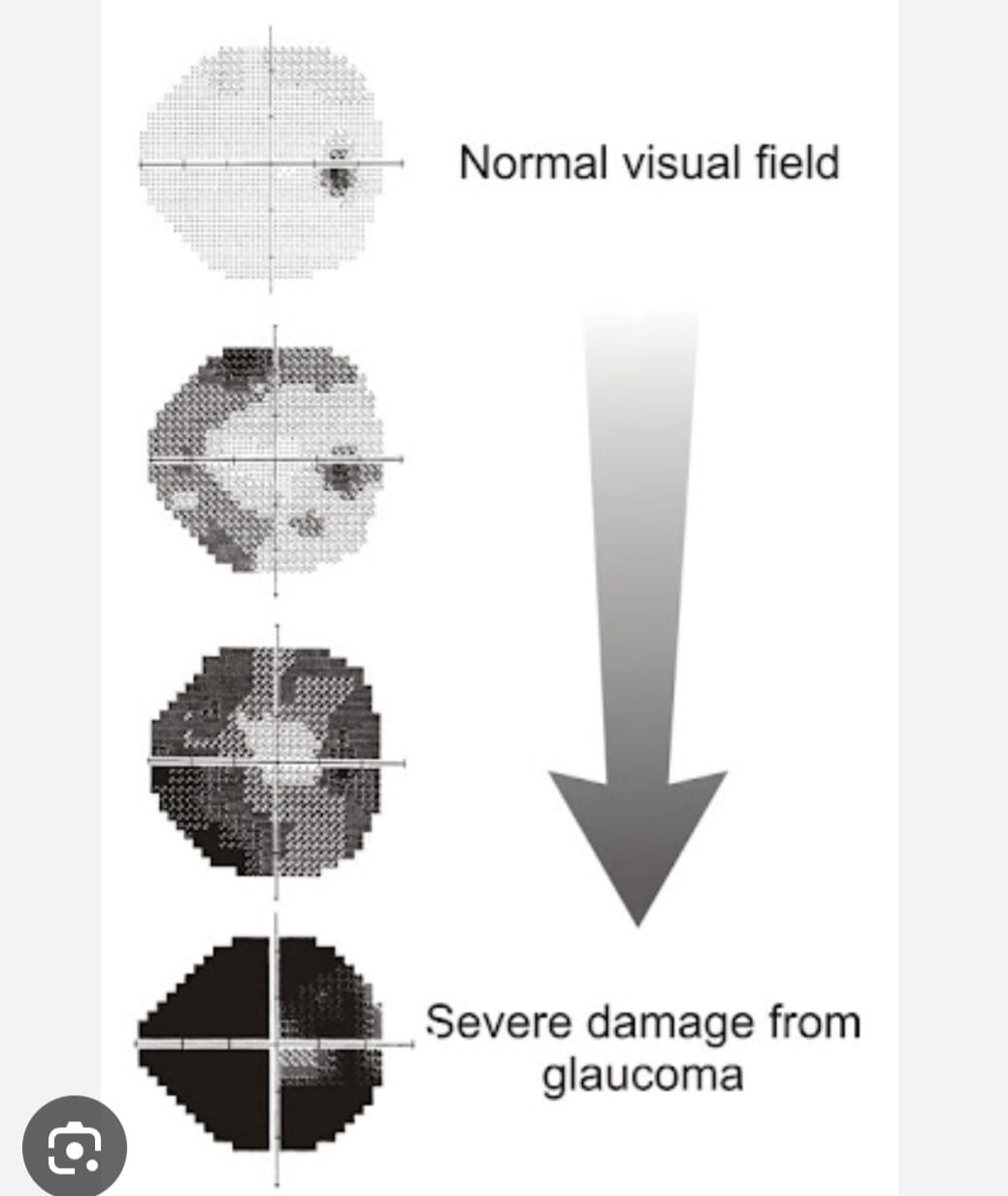 Glaucoma 2