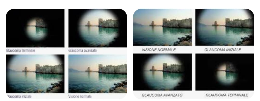 Glaucoma 3